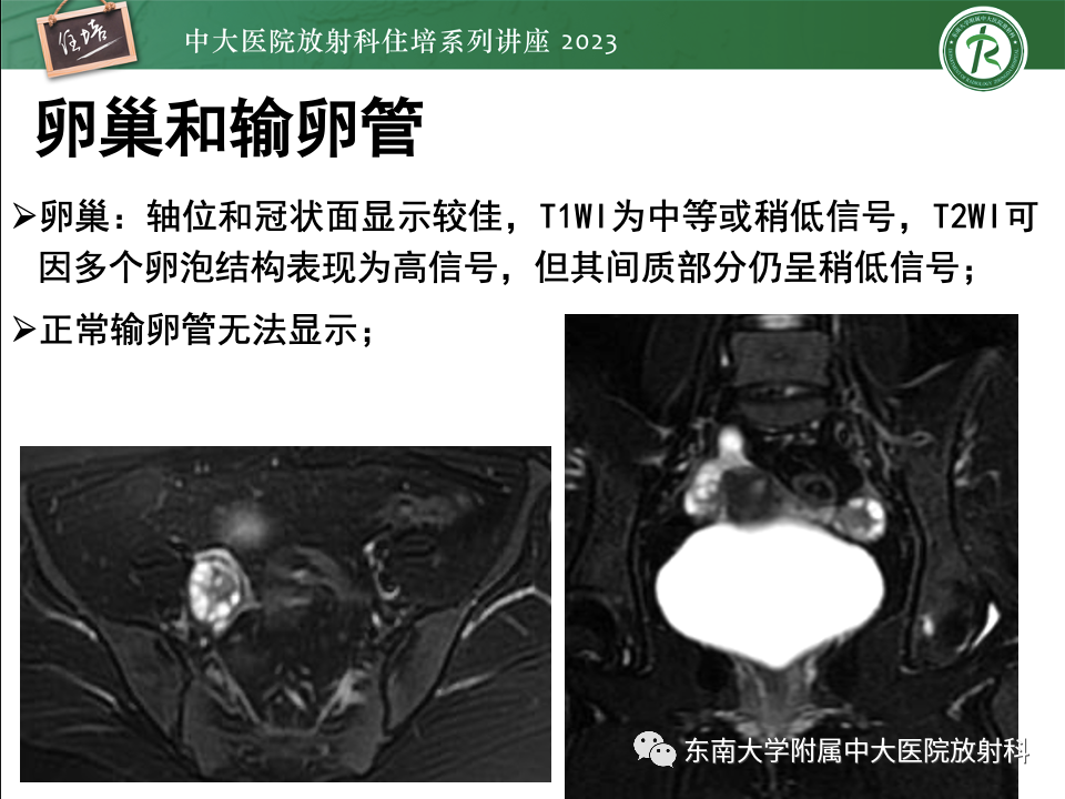 影像PPT - 【PPT】卵巢扭转诊断与鉴别诊断-3