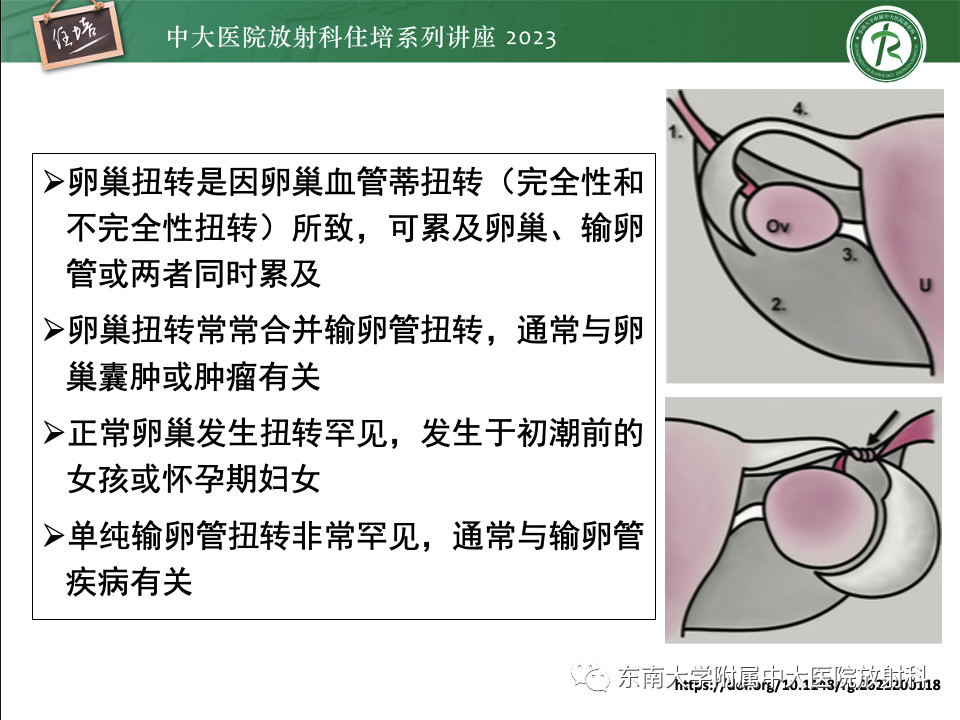 影像PPT - 【PPT】卵巢扭转诊断与鉴别诊断-9