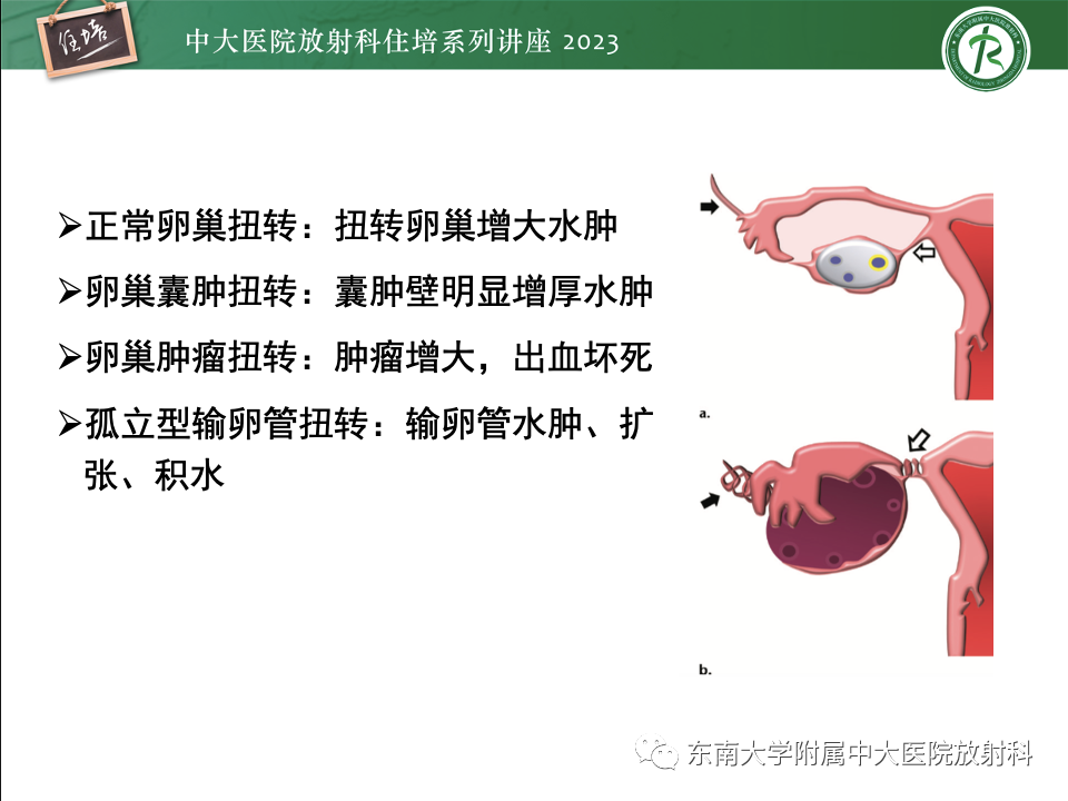 影像PPT - 【PPT】卵巢扭转诊断与鉴别诊断-11
