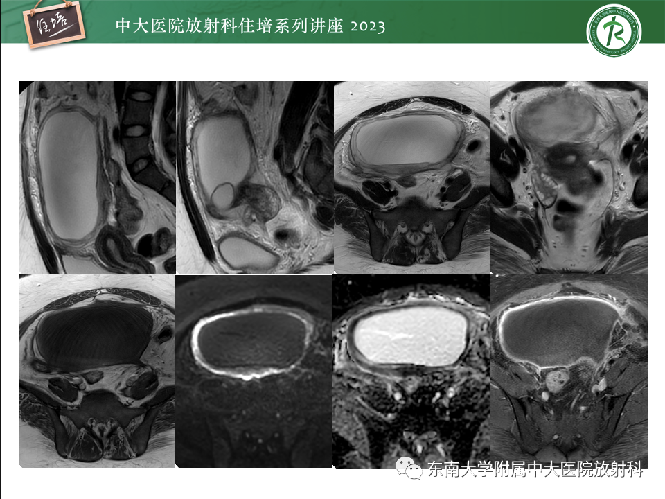 影像PPT - 【PPT】卵巢扭转诊断与鉴别诊断-13