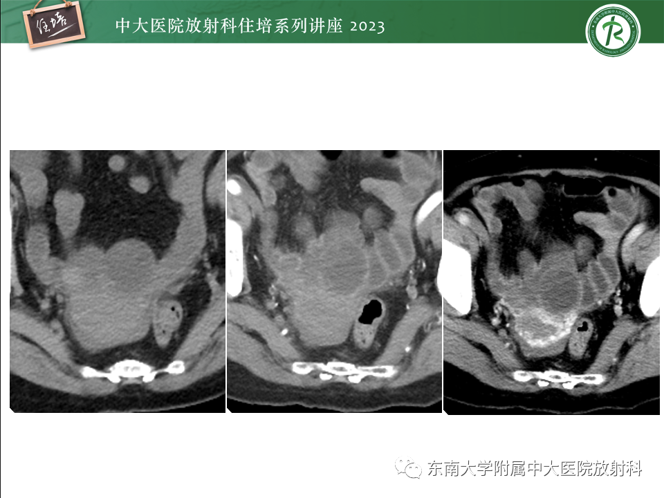 影像PPT - 【PPT】卵巢扭转诊断与鉴别诊断-16
