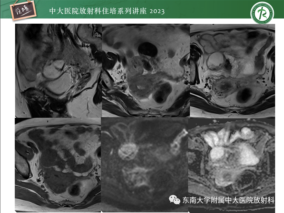影像PPT - 【PPT】卵巢扭转诊断与鉴别诊断-17