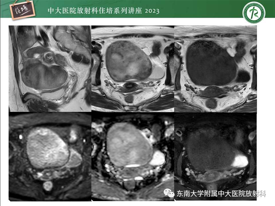 影像PPT - 【PPT】卵巢扭转诊断与鉴别诊断-20