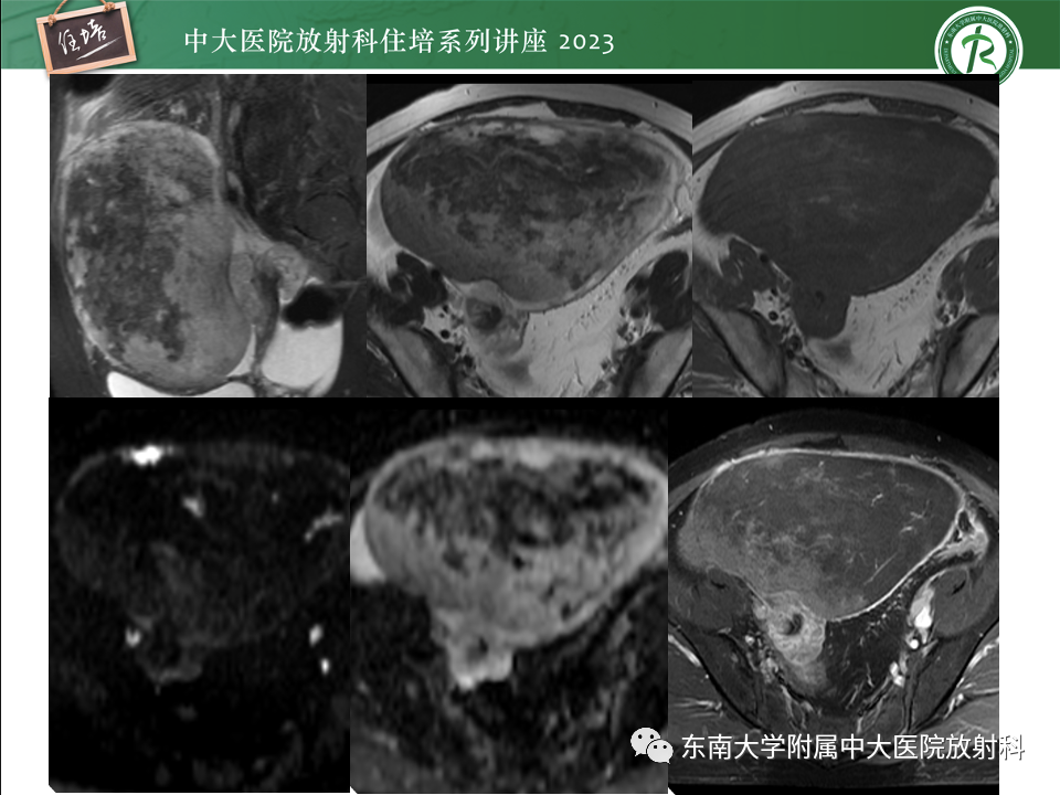 影像PPT - 【PPT】卵巢扭转诊断与鉴别诊断-23