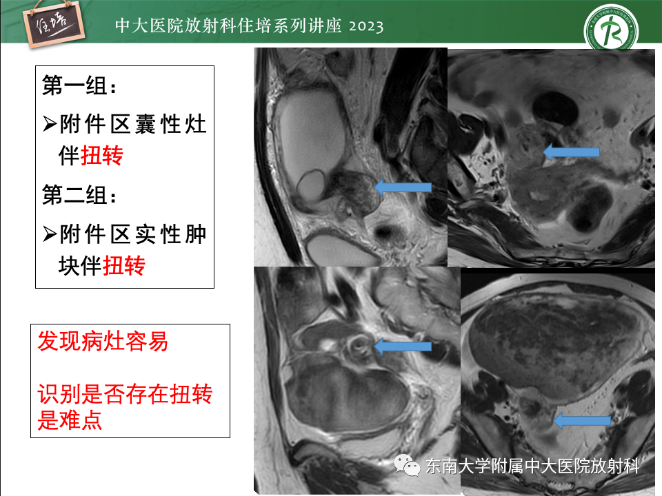 影像PPT - 【PPT】卵巢扭转诊断与鉴别诊断-25
