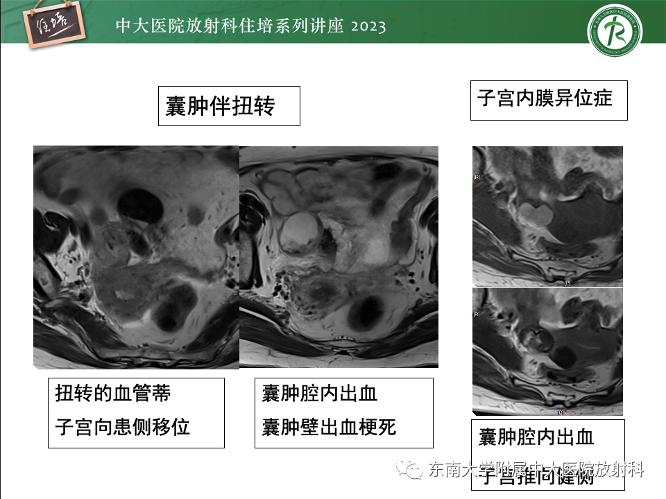 影像PPT - 【PPT】卵巢扭转诊断与鉴别诊断-28