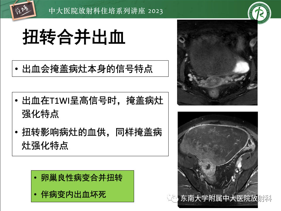 影像PPT - 【PPT】卵巢扭转诊断与鉴别诊断-30