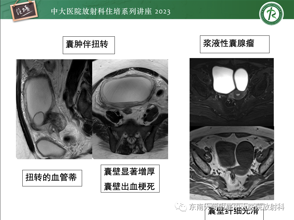 影像PPT - 【PPT】卵巢扭转诊断与鉴别诊断-29