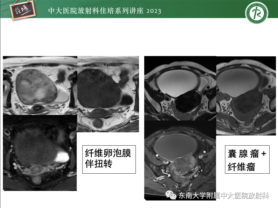 影像PPT - 【PPT】卵巢扭转诊断与鉴别诊断-31