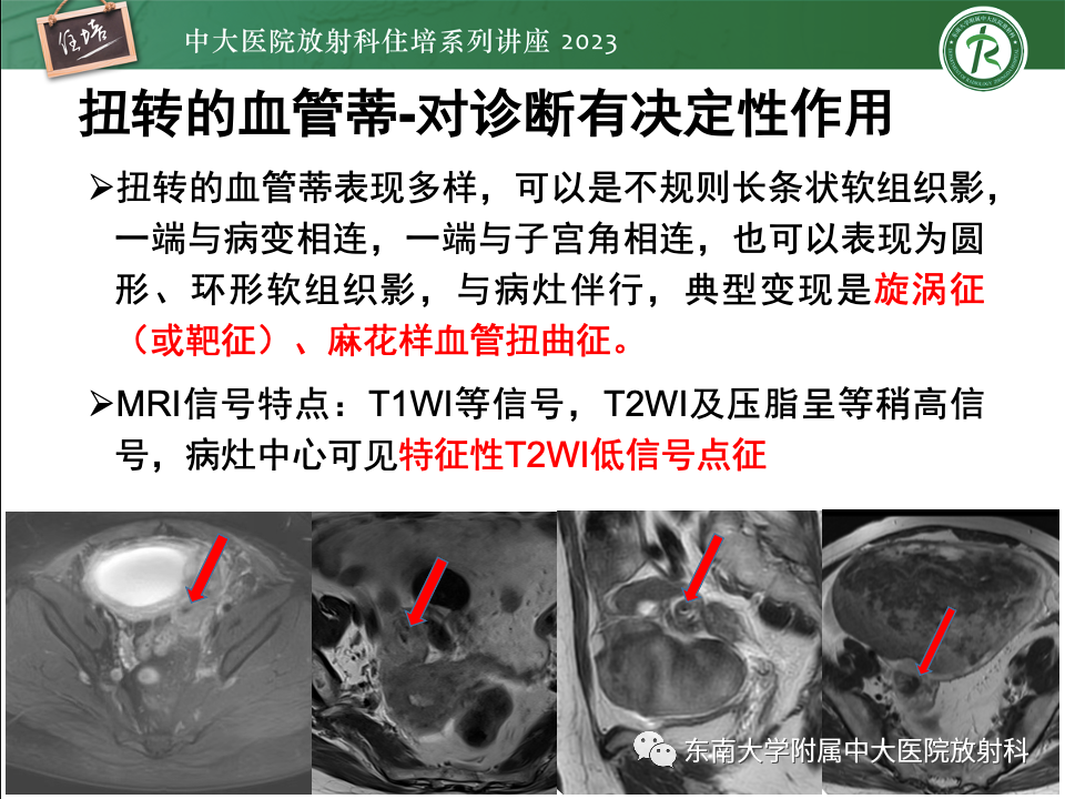 影像PPT - 【PPT】卵巢扭转诊断与鉴别诊断-32
