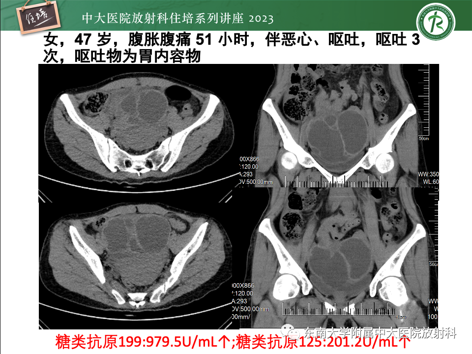 影像PPT - 【PPT】卵巢扭转诊断与鉴别诊断-33