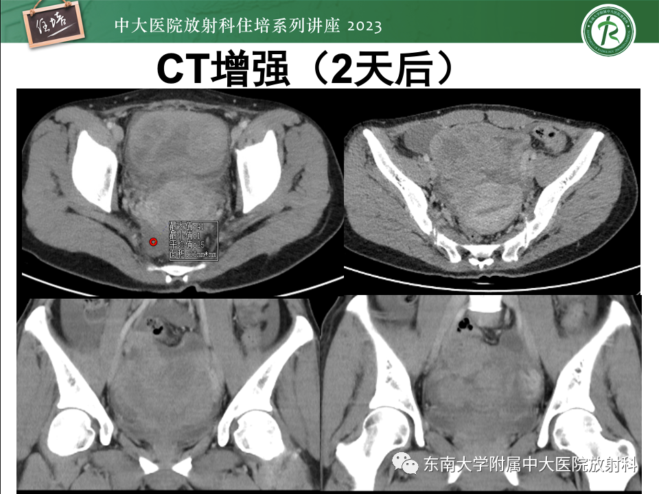 影像PPT - 【PPT】卵巢扭转诊断与鉴别诊断-34