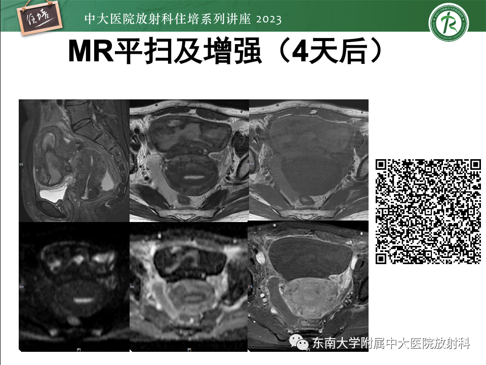 影像PPT - 【PPT】卵巢扭转诊断与鉴别诊断-35