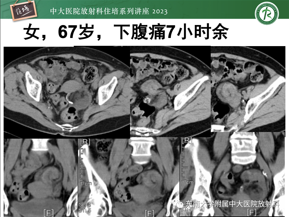 影像PPT - 【PPT】卵巢扭转诊断与鉴别诊断-37