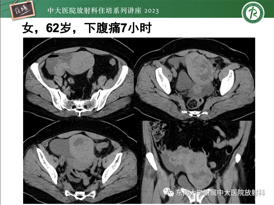 影像PPT - 【PPT】卵巢扭转诊断与鉴别诊断-39