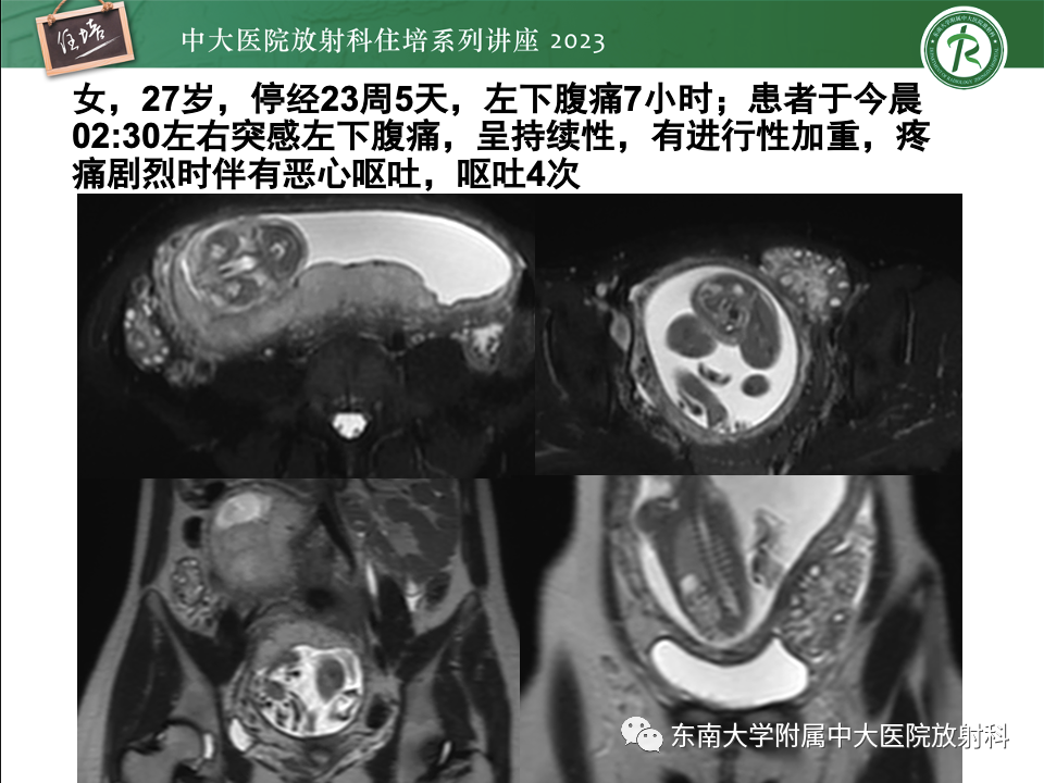 影像PPT - 【PPT】卵巢扭转诊断与鉴别诊断-41