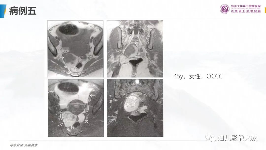 影像PPT - 【PPT】卵巢透明细胞癌-16