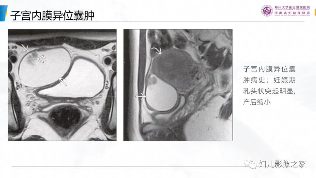 影像PPT - 【PPT】卵巢透明细胞癌-19