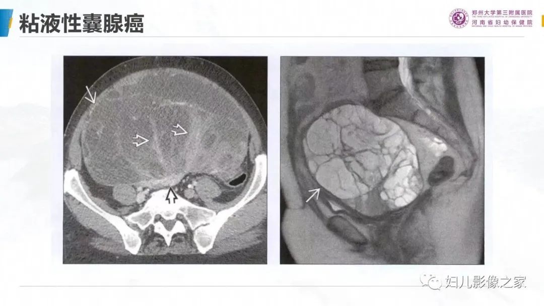 影像PPT - 【PPT】卵巢透明细胞癌-22