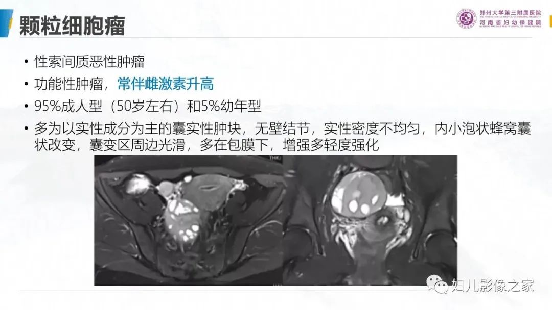 影像PPT - 【PPT】卵巢透明细胞癌-23