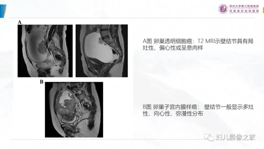 影像PPT - 【PPT】卵巢透明细胞癌-27