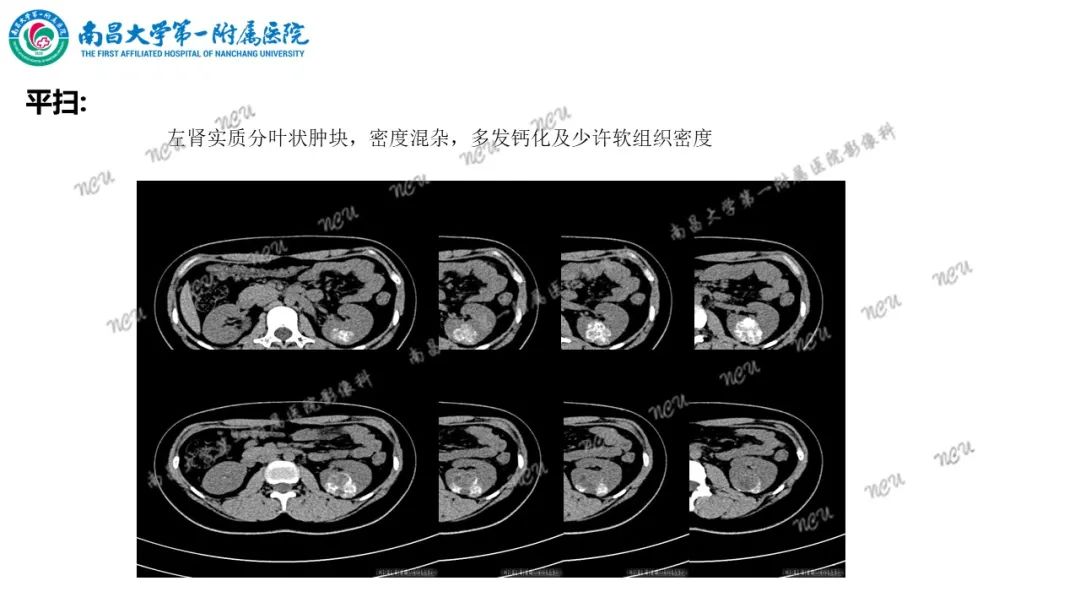 影像PPT - 【病例】MiT家族易位性肾细胞癌-3