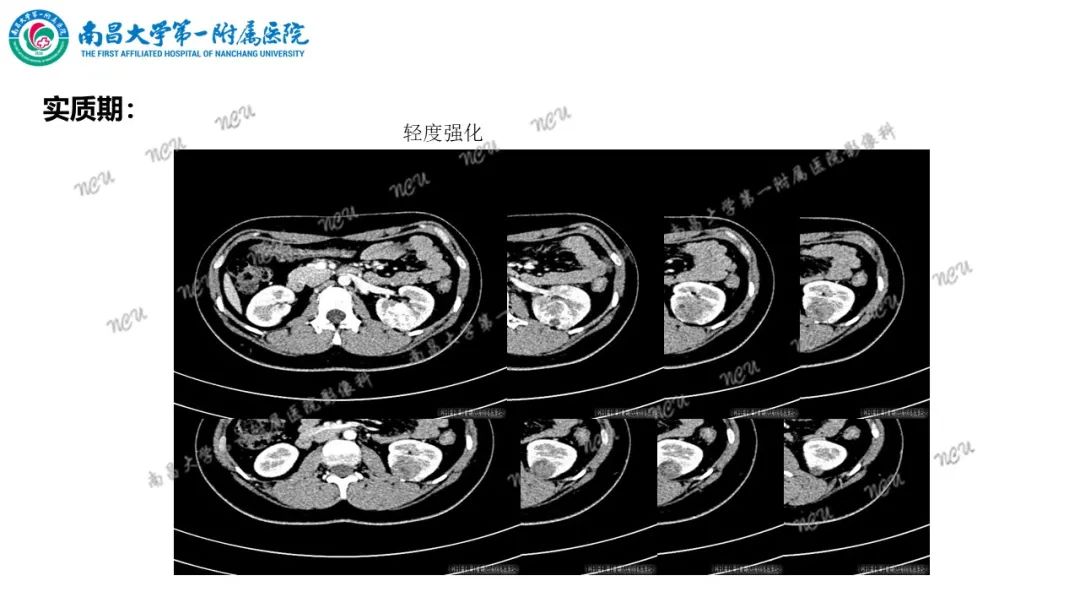 影像PPT - 【病例】MiT家族易位性肾细胞癌-5