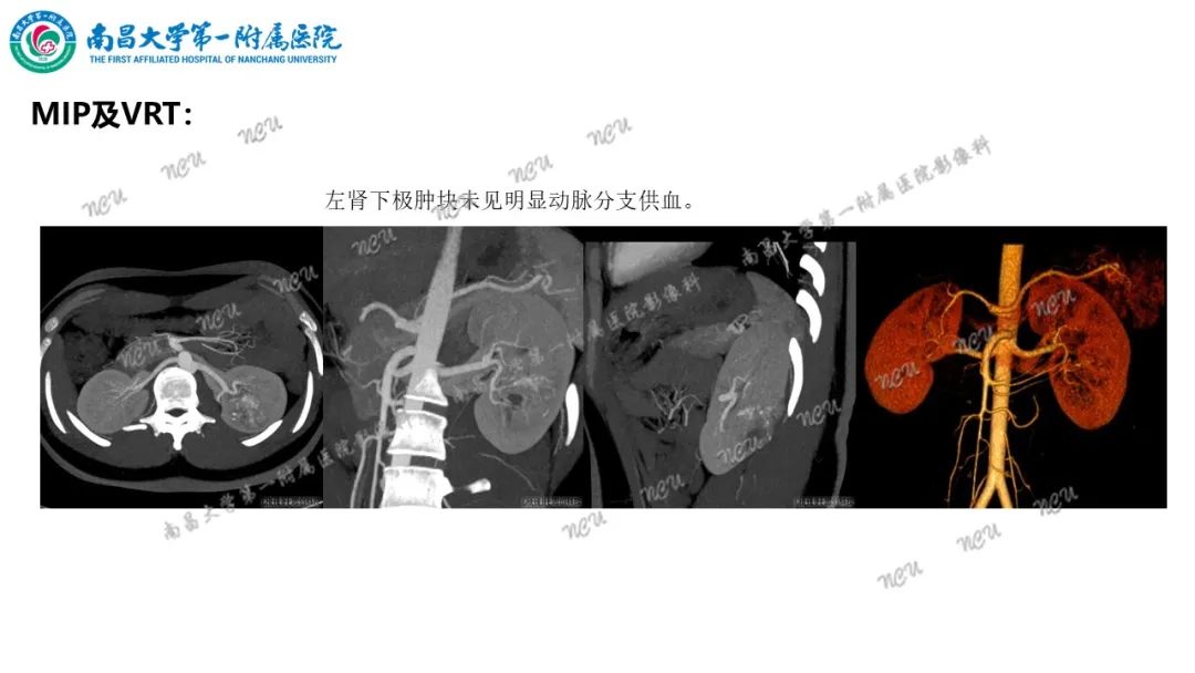 影像PPT - 【病例】MiT家族易位性肾细胞癌-7