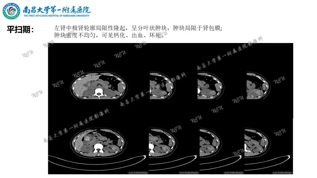 影像PPT - 【病例】MiT家族易位性肾细胞癌-12