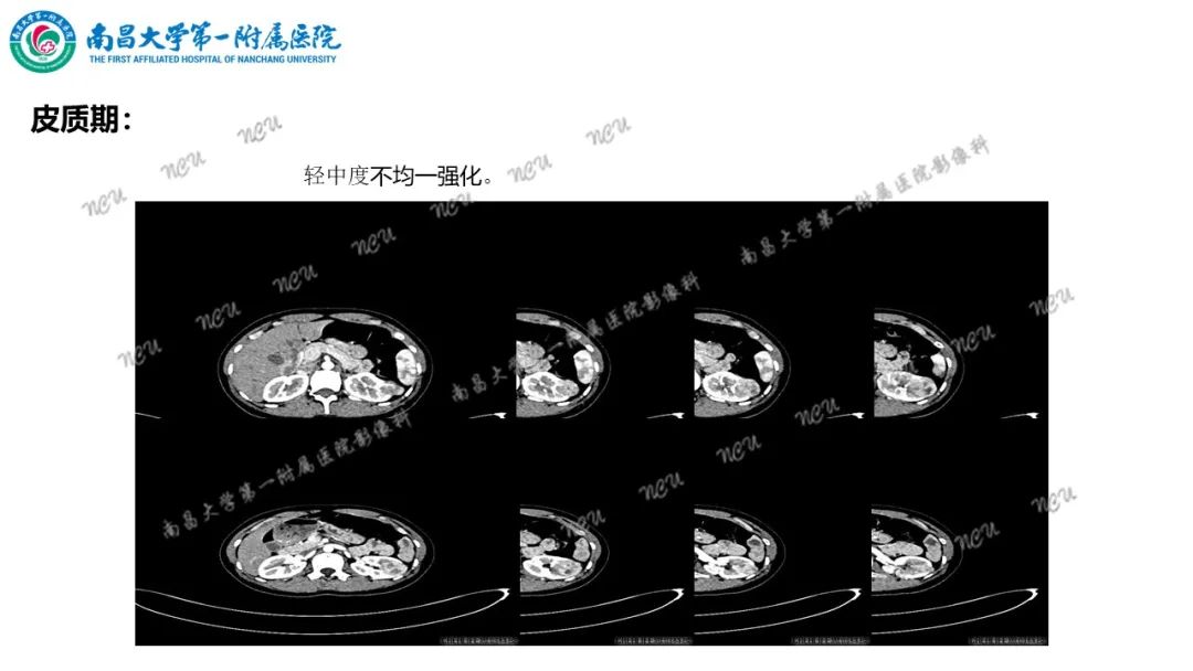 影像PPT - 【病例】MiT家族易位性肾细胞癌-13