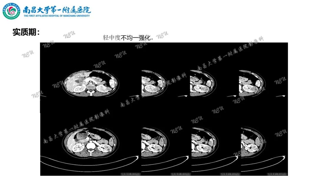影像PPT - 【病例】MiT家族易位性肾细胞癌-14