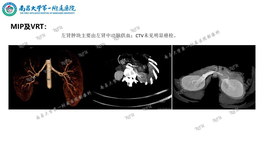 影像PPT - 【病例】MiT家族易位性肾细胞癌-15
