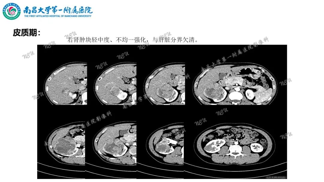 影像PPT - 【病例】MiT家族易位性肾细胞癌-20