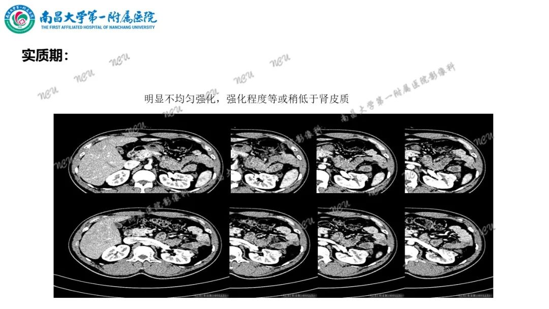 影像PPT - 【病例】MiT家族易位性肾细胞癌-38