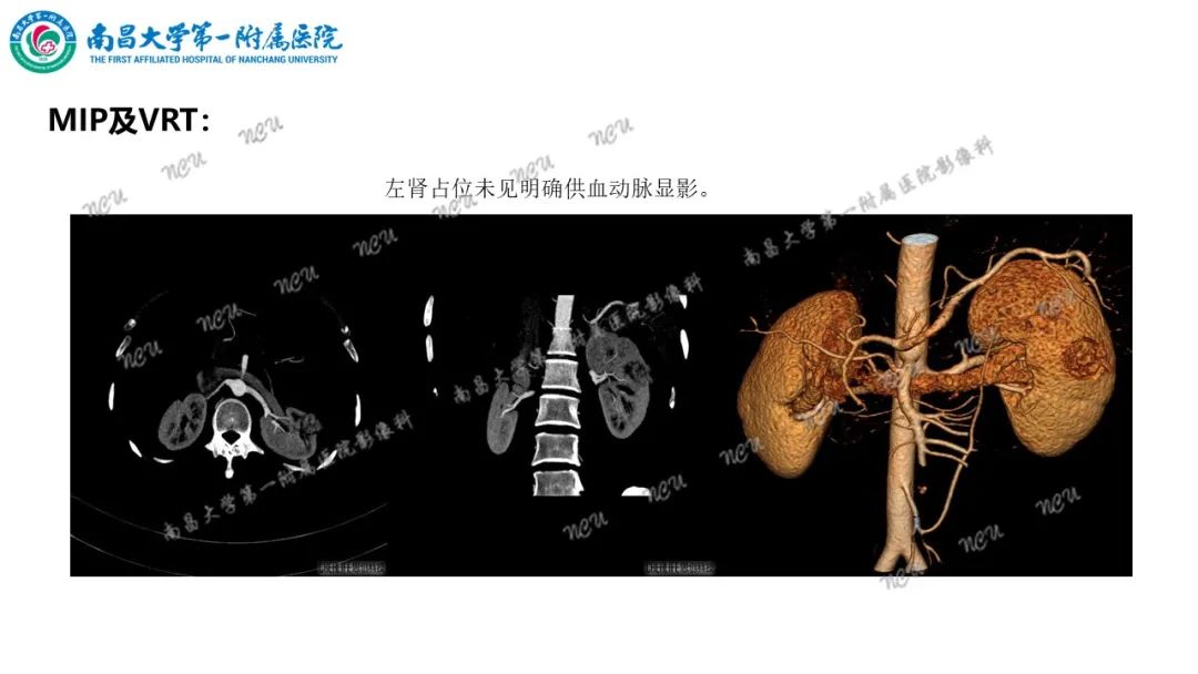 影像PPT - 【病例】MiT家族易位性肾细胞癌-40