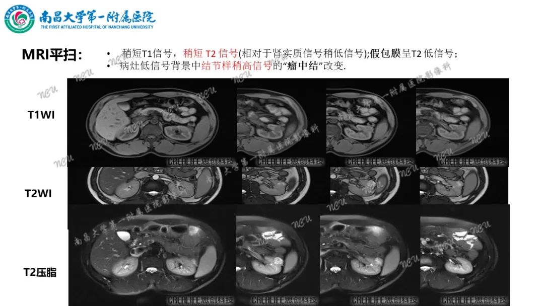 影像PPT - 【病例】MiT家族易位性肾细胞癌-41