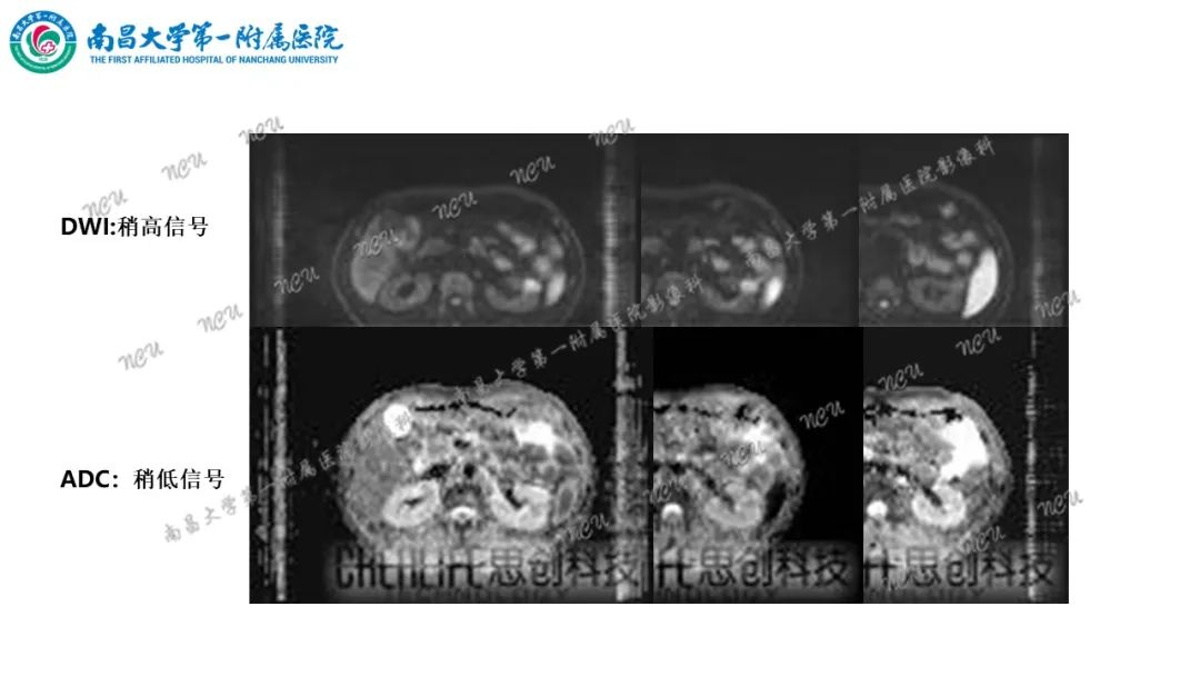 影像PPT - 【病例】MiT家族易位性肾细胞癌-42