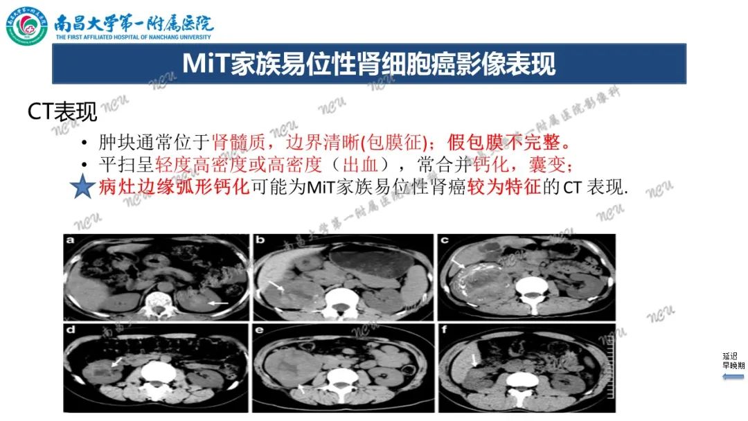 影像PPT - 【病例】MiT家族易位性肾细胞癌-54