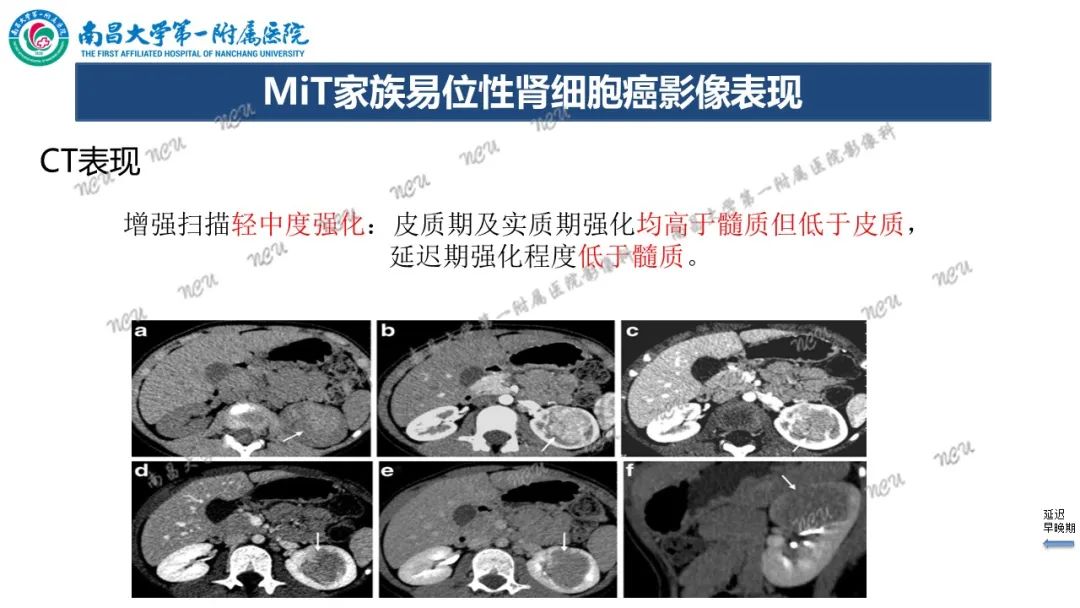 影像PPT - 【病例】MiT家族易位性肾细胞癌-55