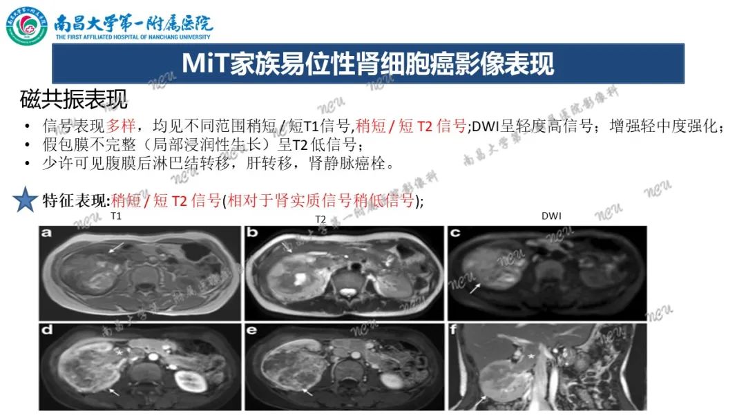 影像PPT - 【病例】MiT家族易位性肾细胞癌-56