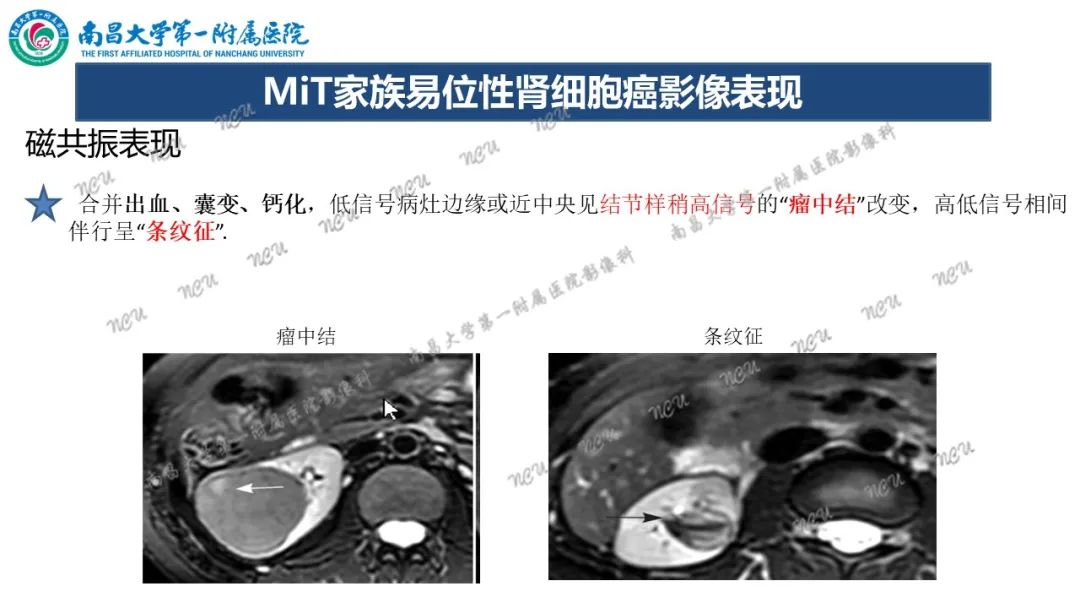 影像PPT - 【病例】MiT家族易位性肾细胞癌-57
