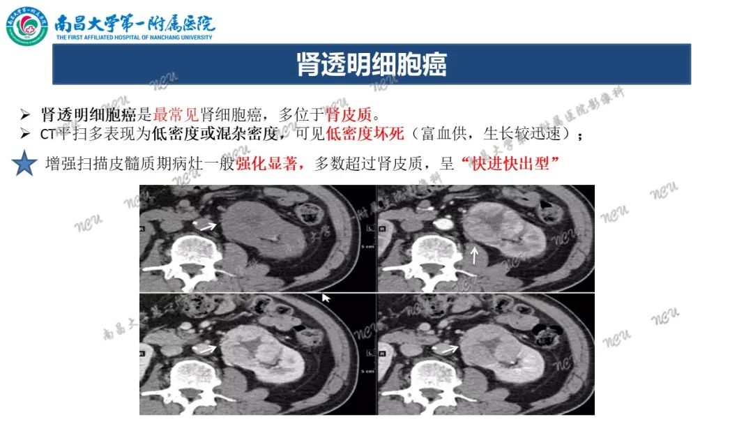 影像PPT - 【病例】MiT家族易位性肾细胞癌-60