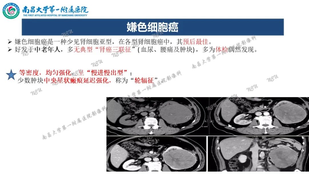 影像PPT - 【病例】MiT家族易位性肾细胞癌-63