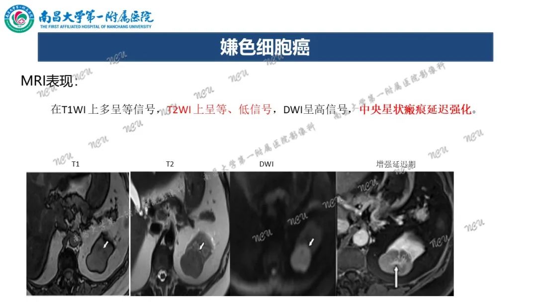 影像PPT - 【病例】MiT家族易位性肾细胞癌-64
