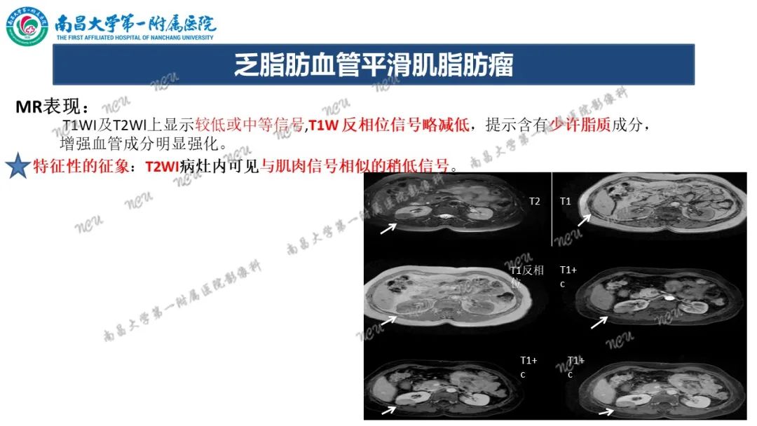 影像PPT - 【病例】MiT家族易位性肾细胞癌-66