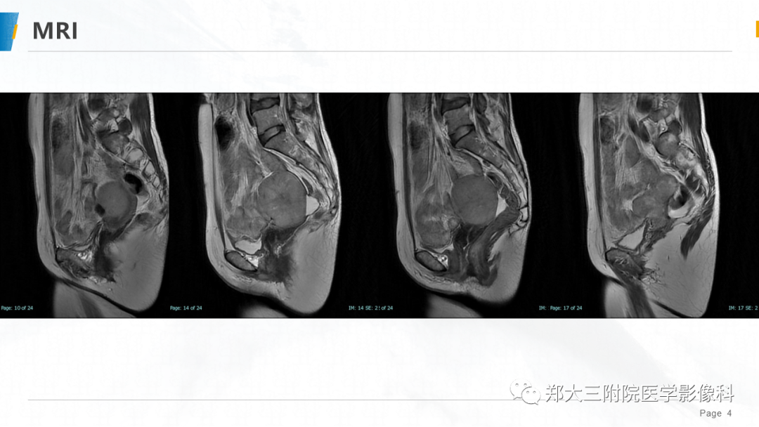 影像PPT - 【PPT】子宫中肾样腺癌-4