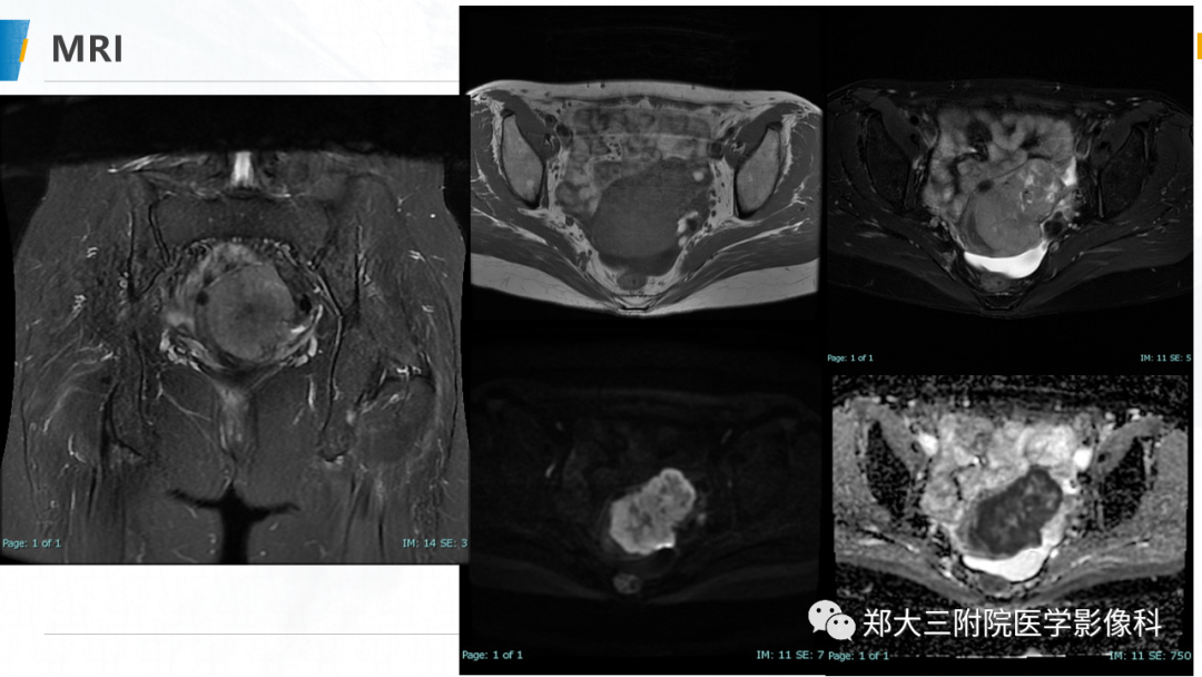 影像PPT - 【PPT】子宫中肾样腺癌-5