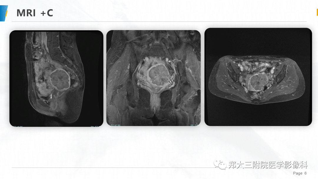 影像PPT - 【PPT】子宫中肾样腺癌-6