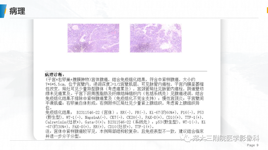 影像PPT - 【PPT】子宫中肾样腺癌-9