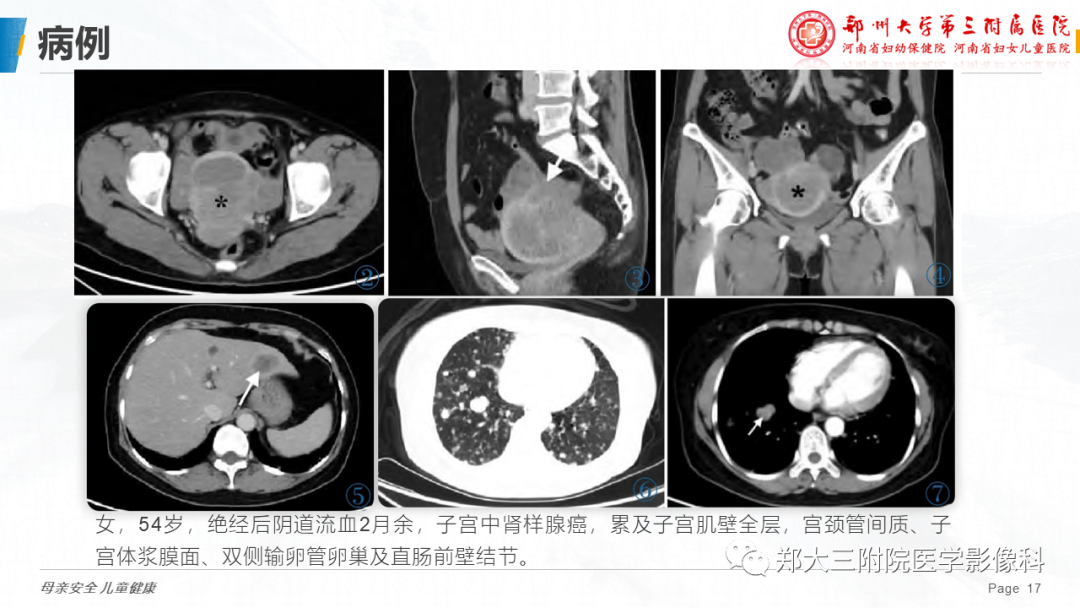 影像PPT - 【PPT】子宫中肾样腺癌-17